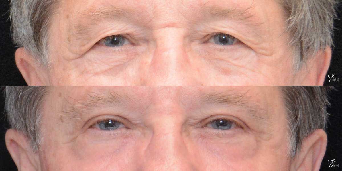 Male Face Neck Lift Before & After