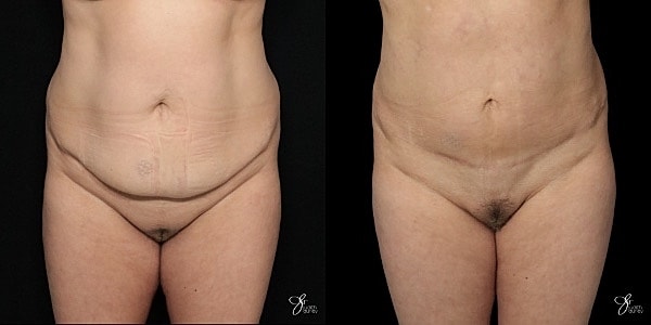 Mini Tummy Tuck Before & After