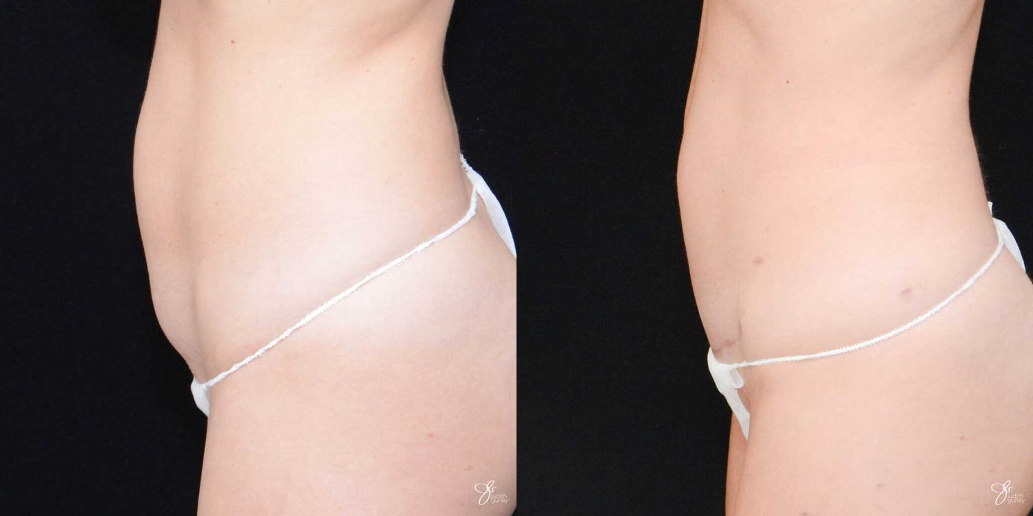 Mini Tummy Tuck Before & After