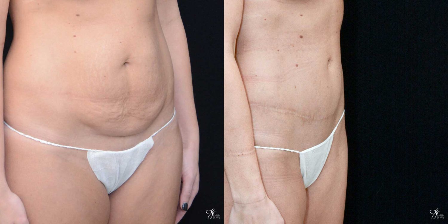 Mini Tummy Tuck Before & After