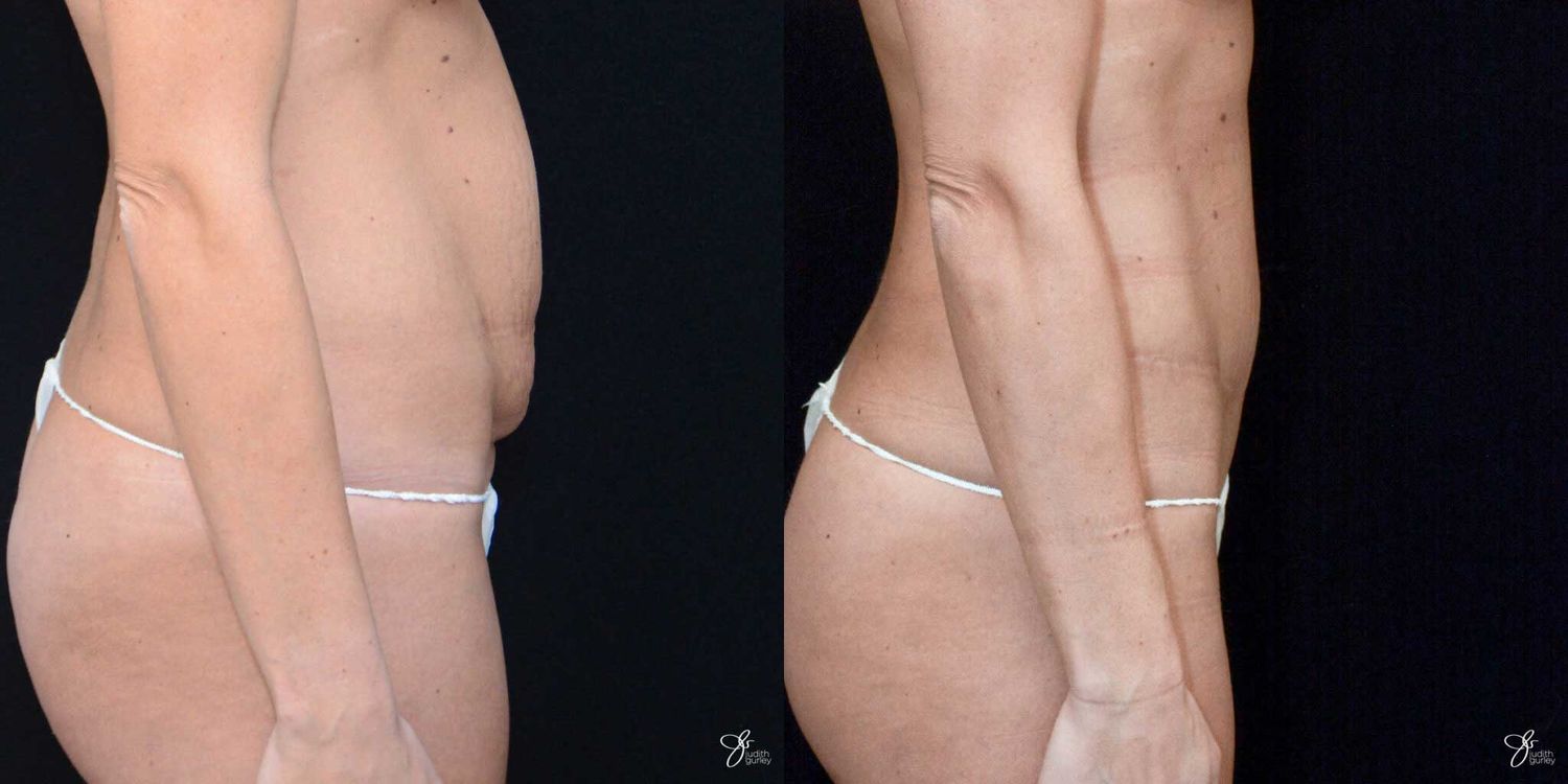 Mini Tummy Tuck Before & After