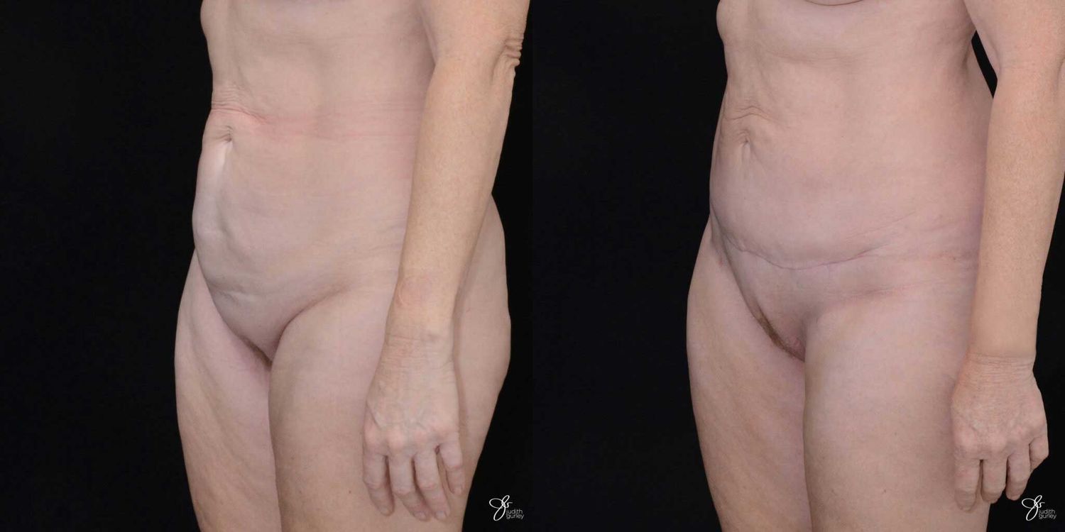 Mini Tummy Tuck Before & After