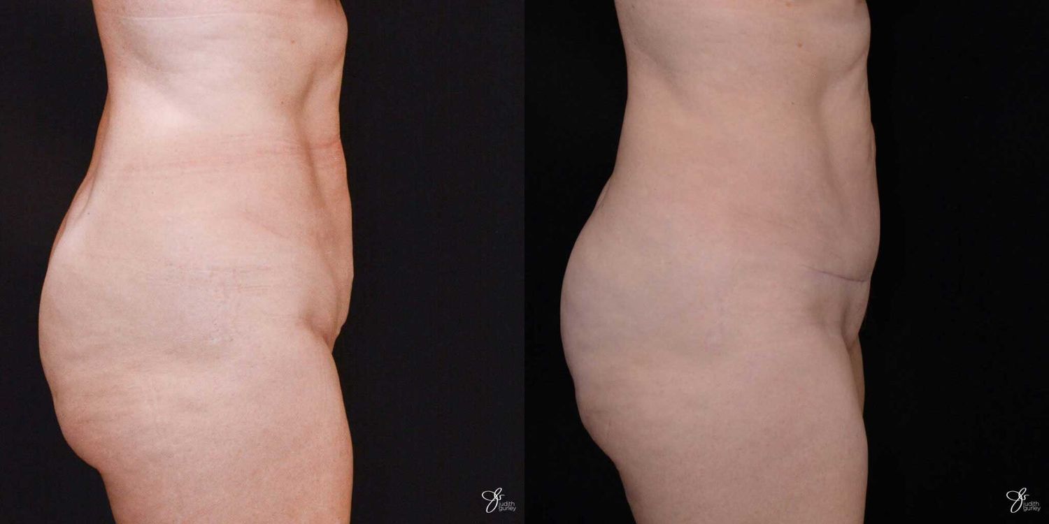 Mini Tummy Tuck Before & After