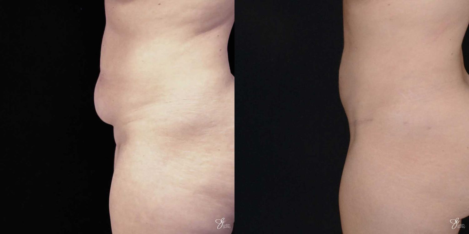 Mini Tummy Tuck Before & After
