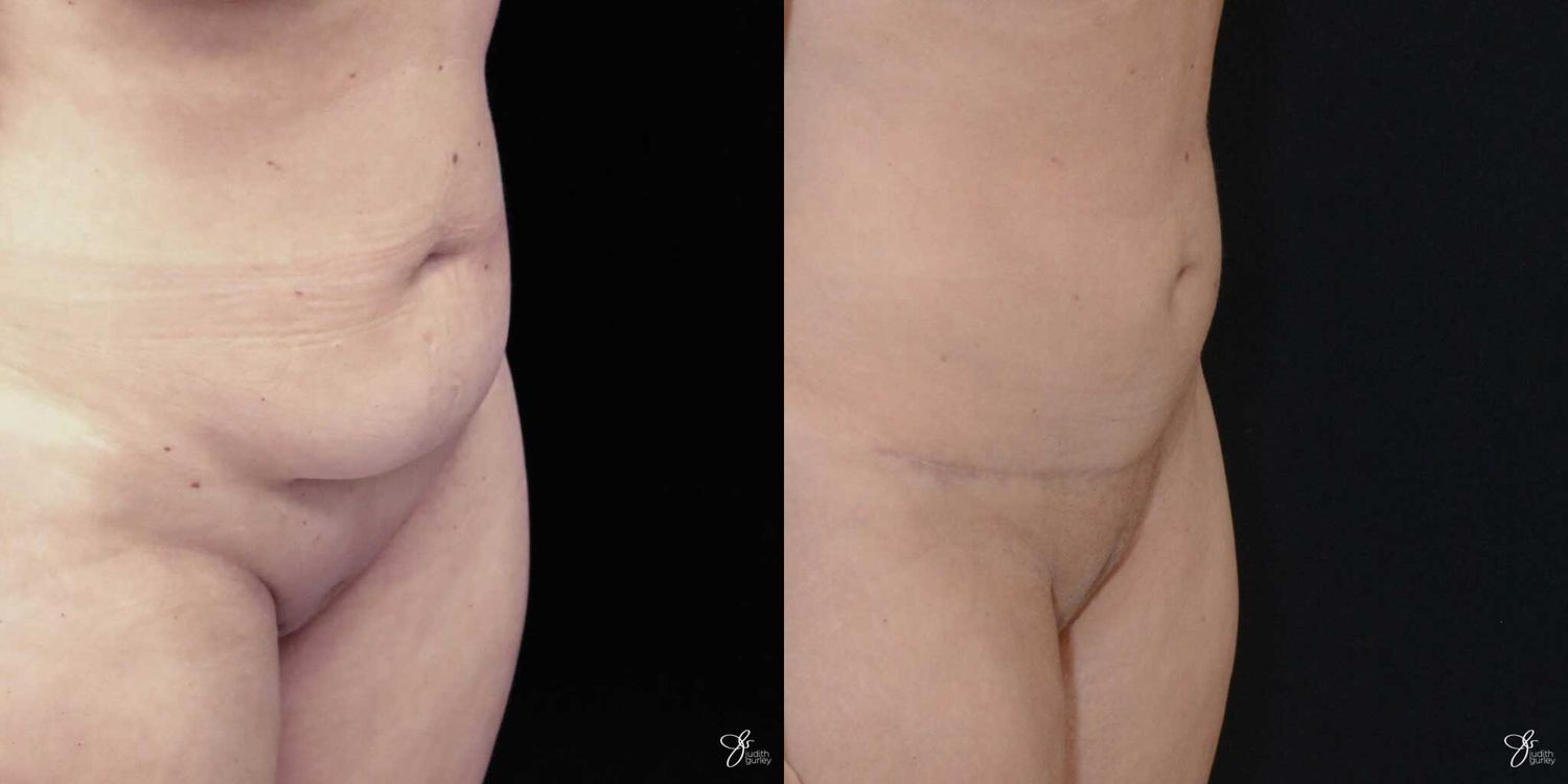 Mini Tummy Tuck Before & After