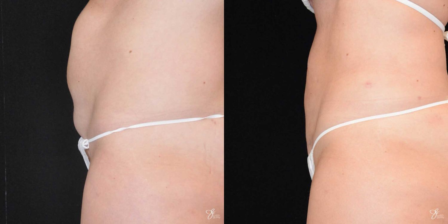 Mini Tummy Tuck Before & After