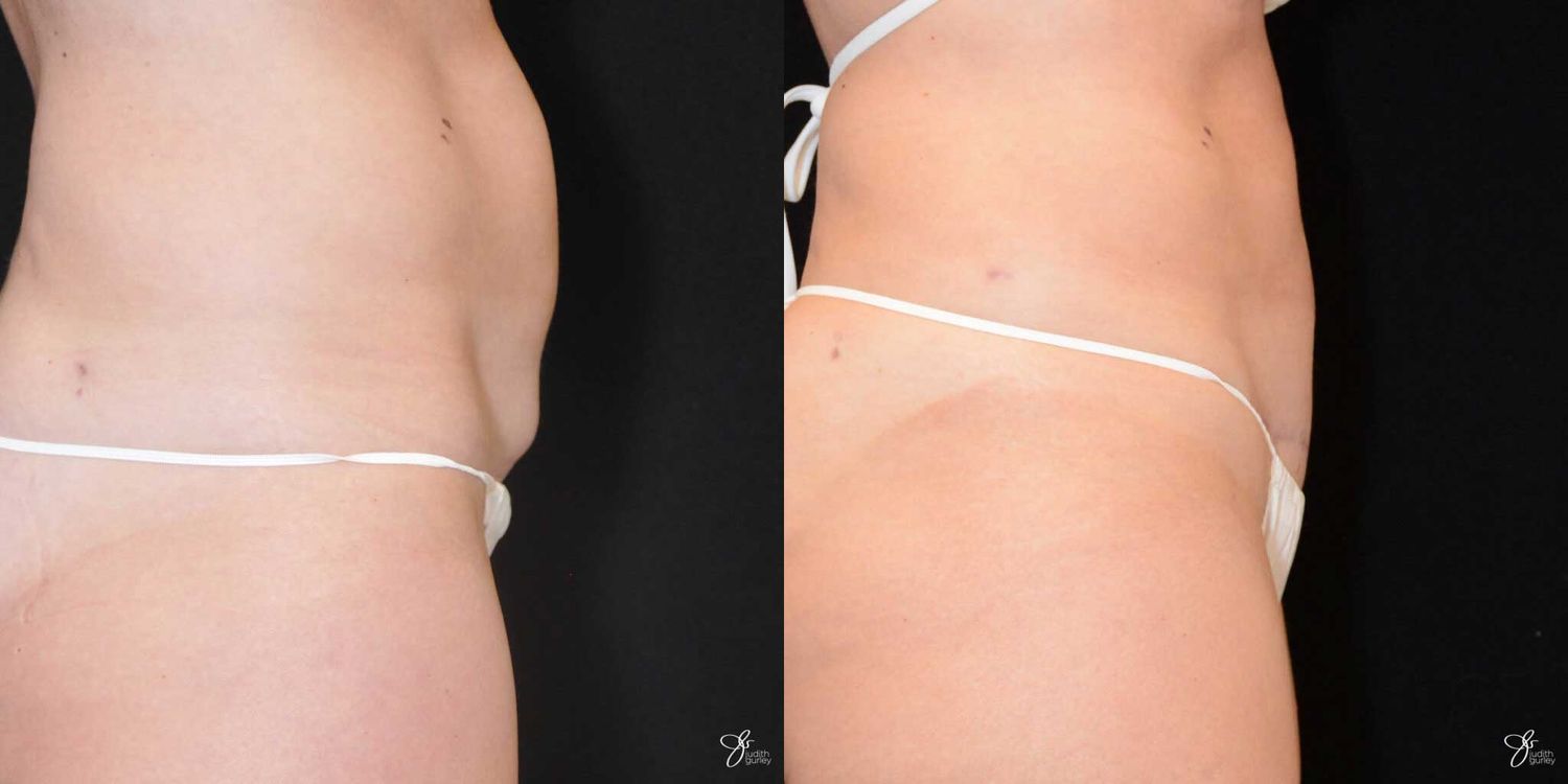 Mini Tummy Tuck Before & After