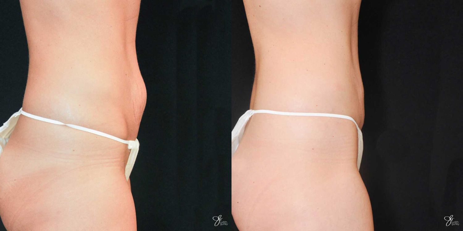 Mini Tummy Tuck Before & After