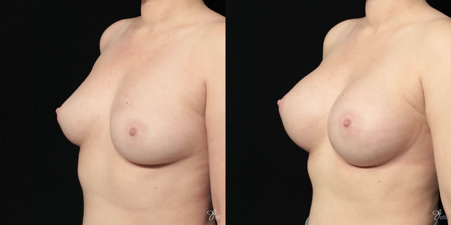 Breast Augmentation Before & After