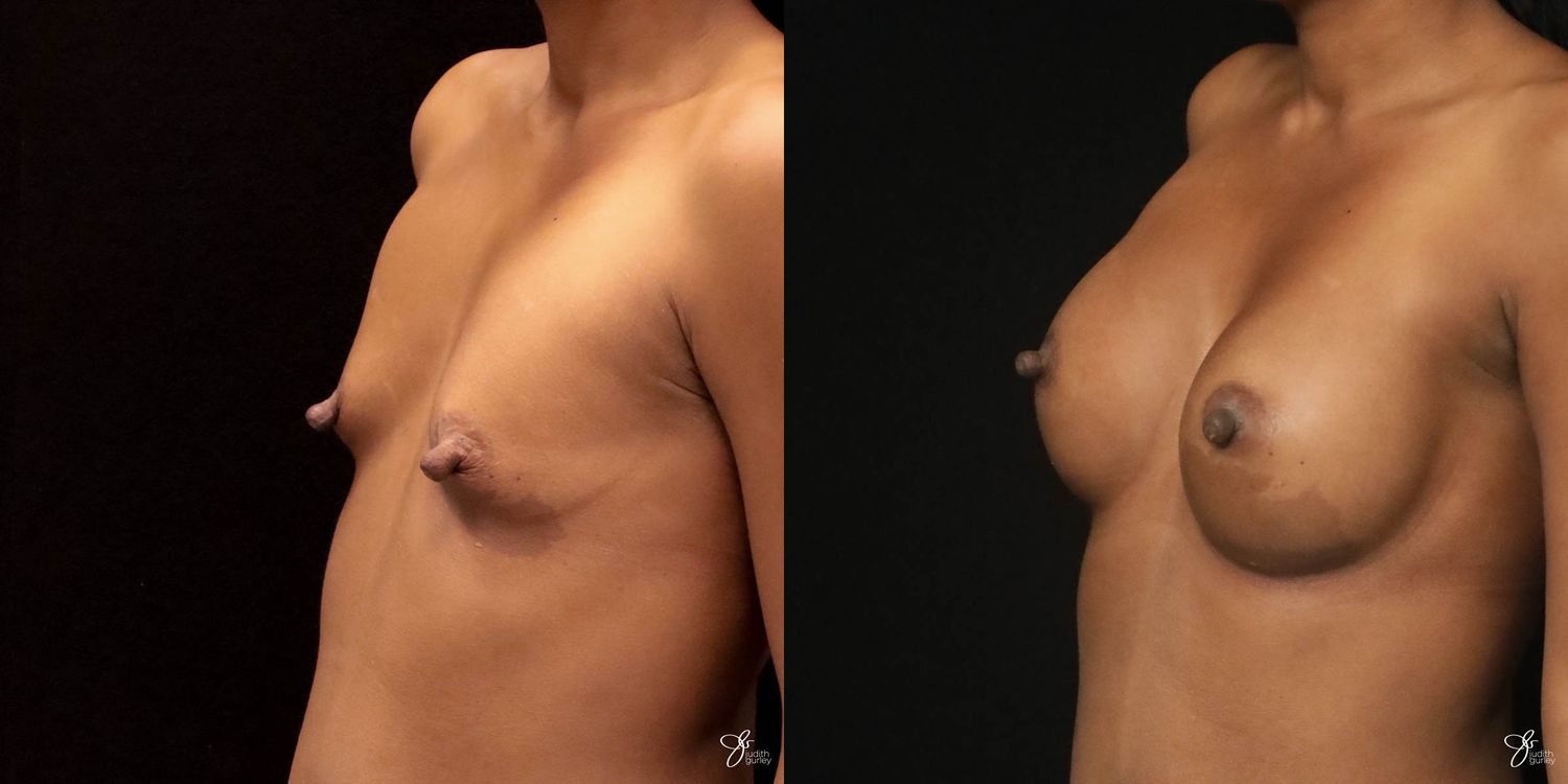 Breast Augmentation Before & After
