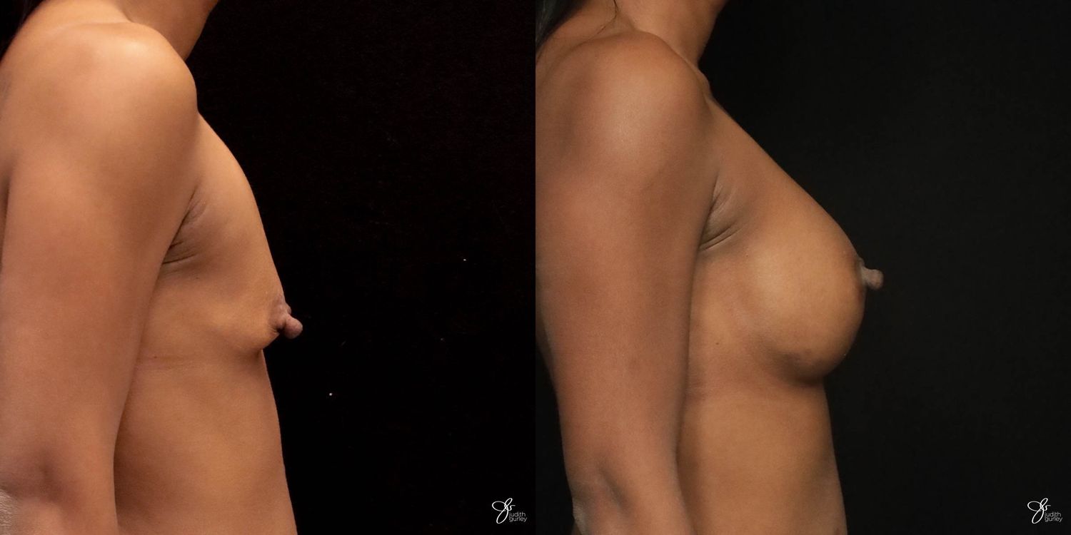 Breast Augmentation Before & After