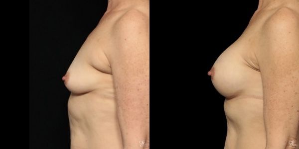 Breast Augmentation Before & After