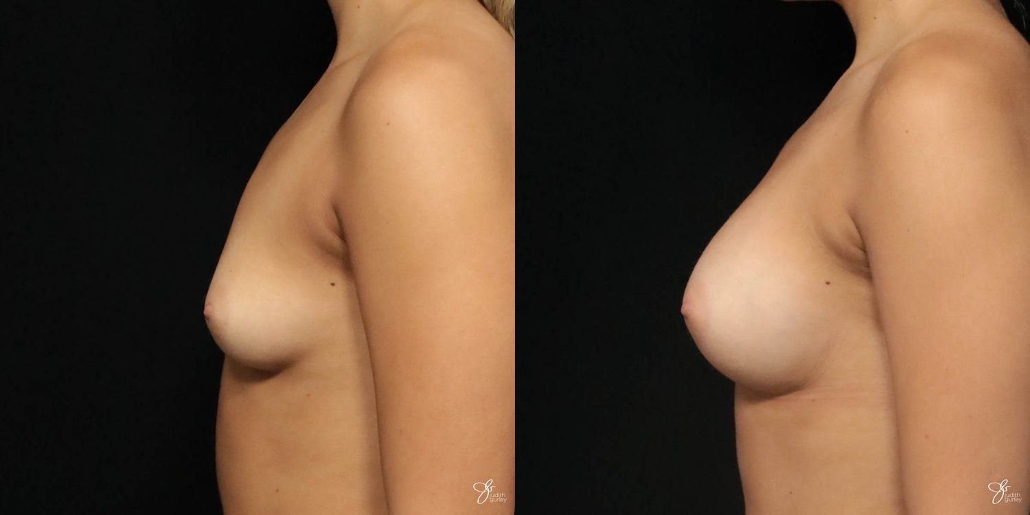 Breast Augmentation Before & After
