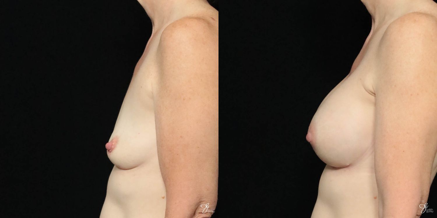 Breast Augmentation Before & After