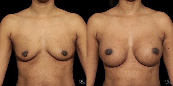 Breast Augmentation Before & After