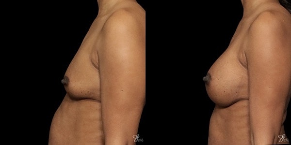 Breast Augmentation Before & After