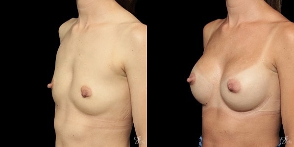 Breast Augmentation Before & After