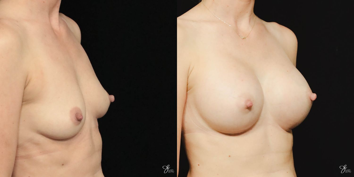 Breast Augmentation Before & After