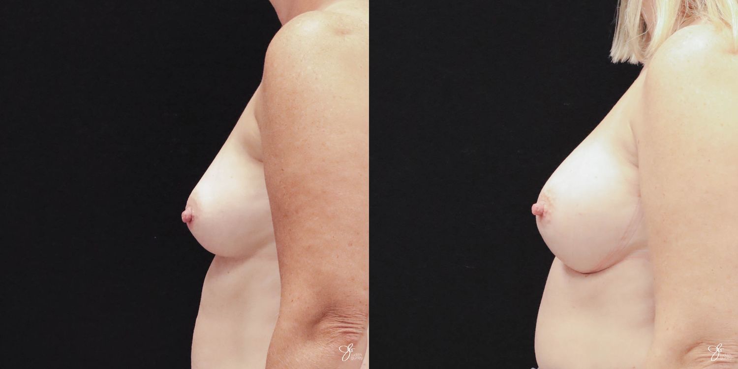 Breast Augmentation Before & After