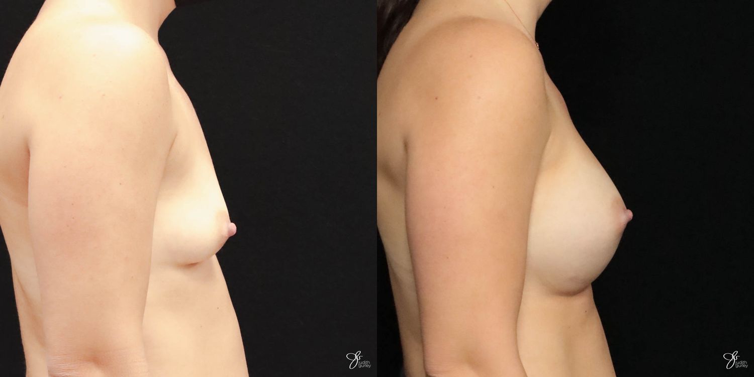 Breast Augmentation Before & After