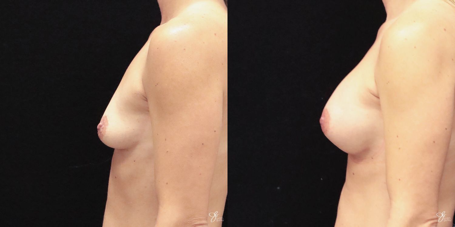 Breast Augmentation Before & After