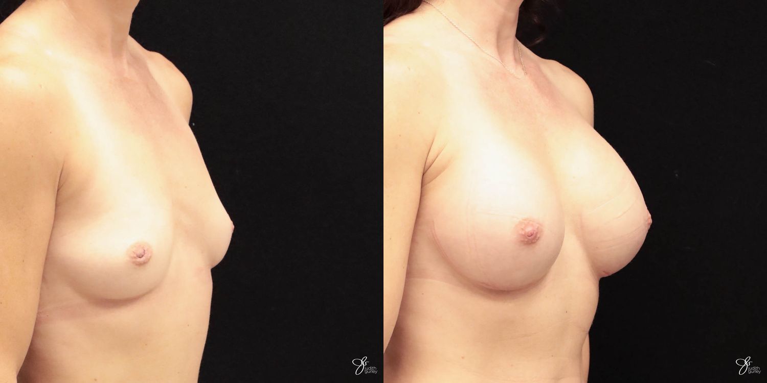 Breast Augmentation Before & After