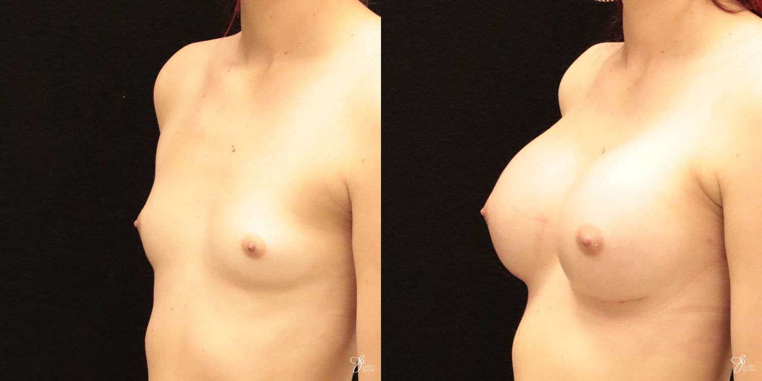 Breast Augmentation Before & After