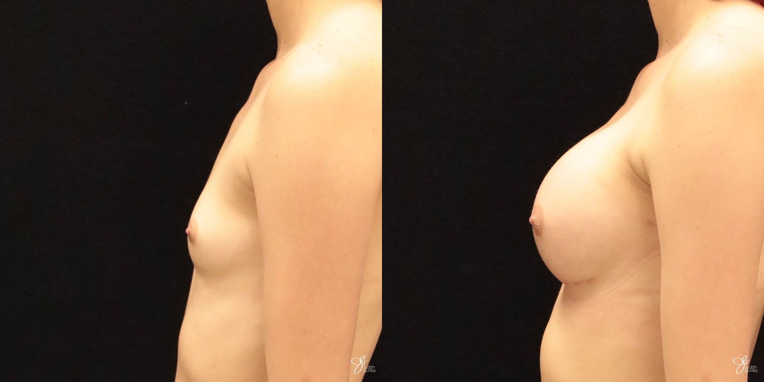 Breast Augmentation Before & After