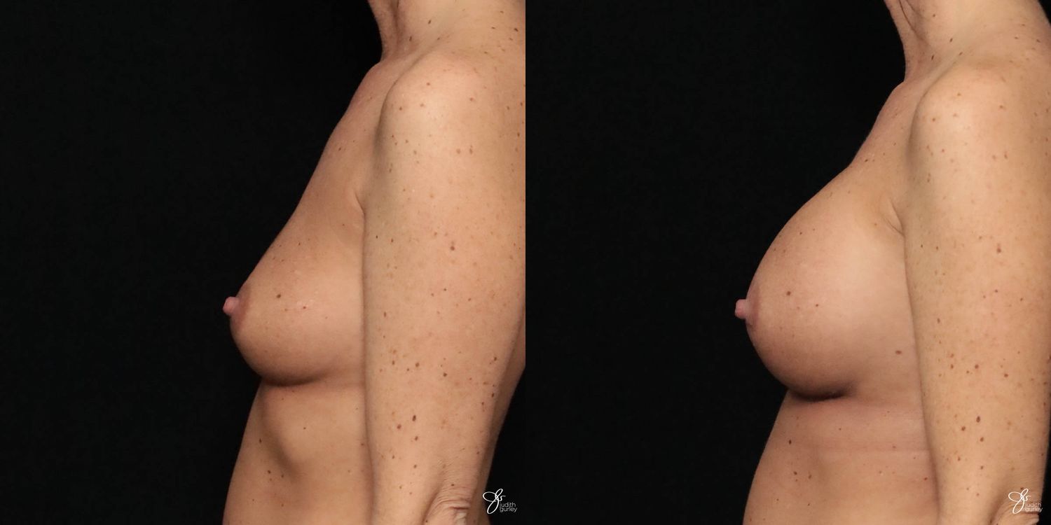 Breast Augmentation Before & After