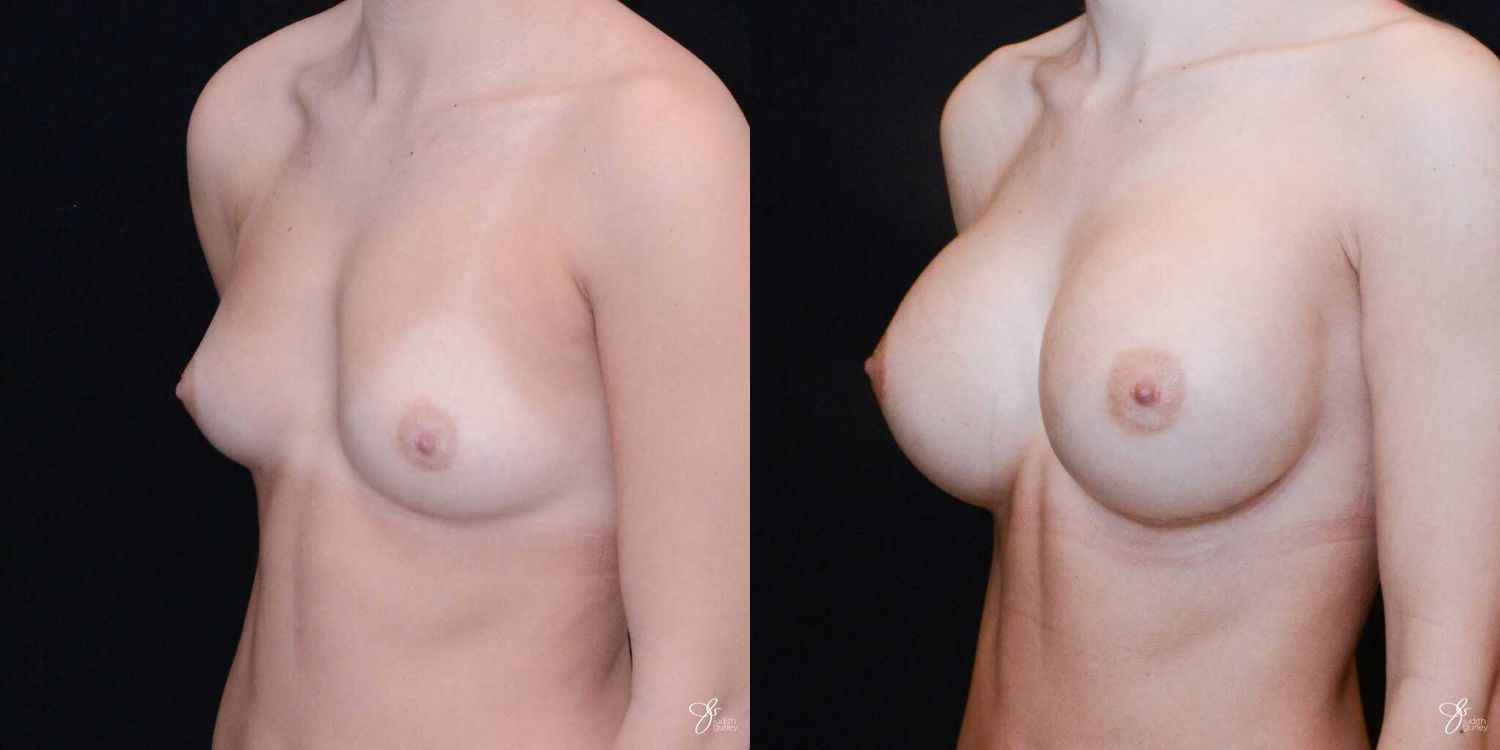 Breast Augmentation Before & After