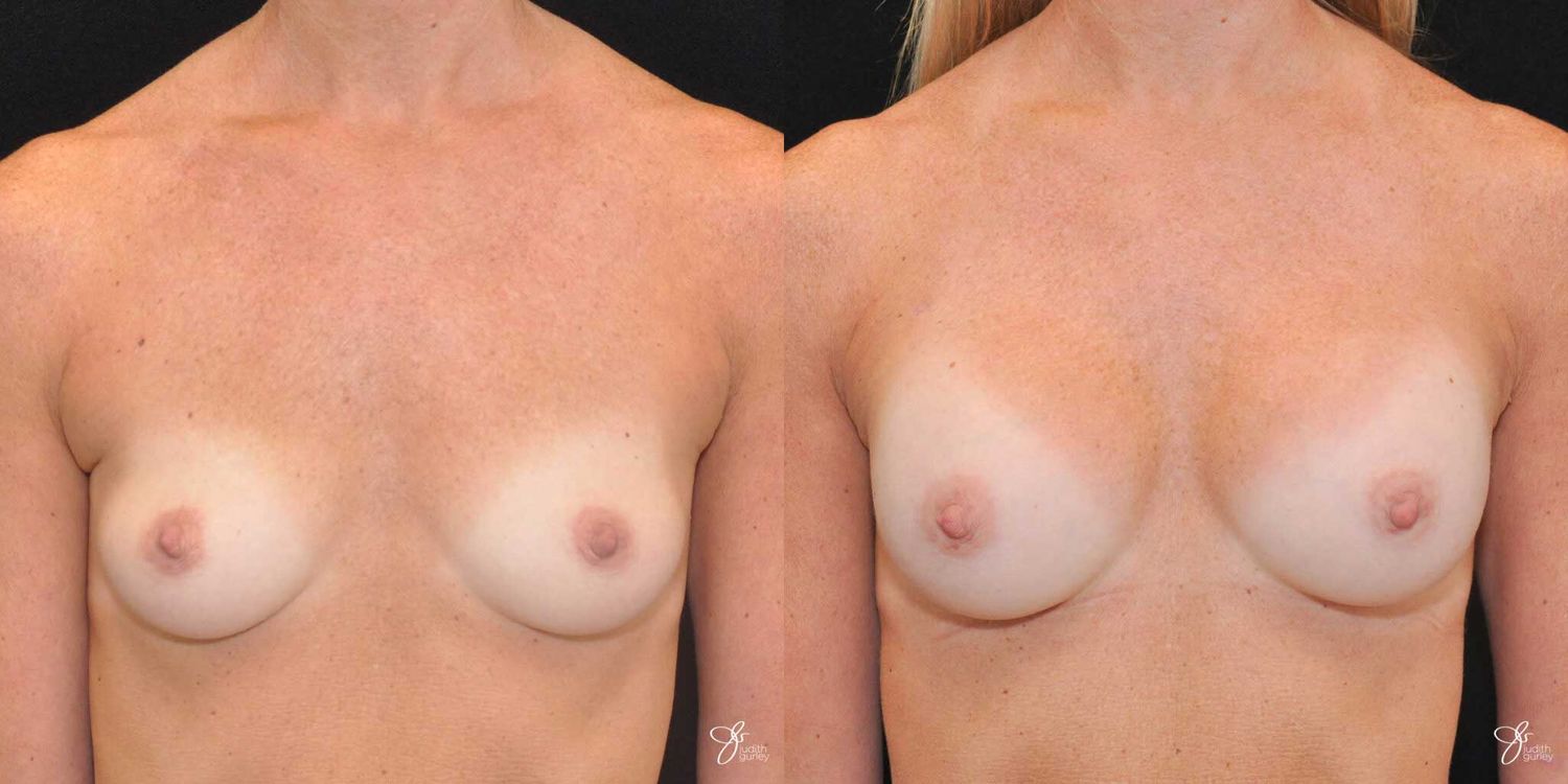 Breast Augmentation Before & After