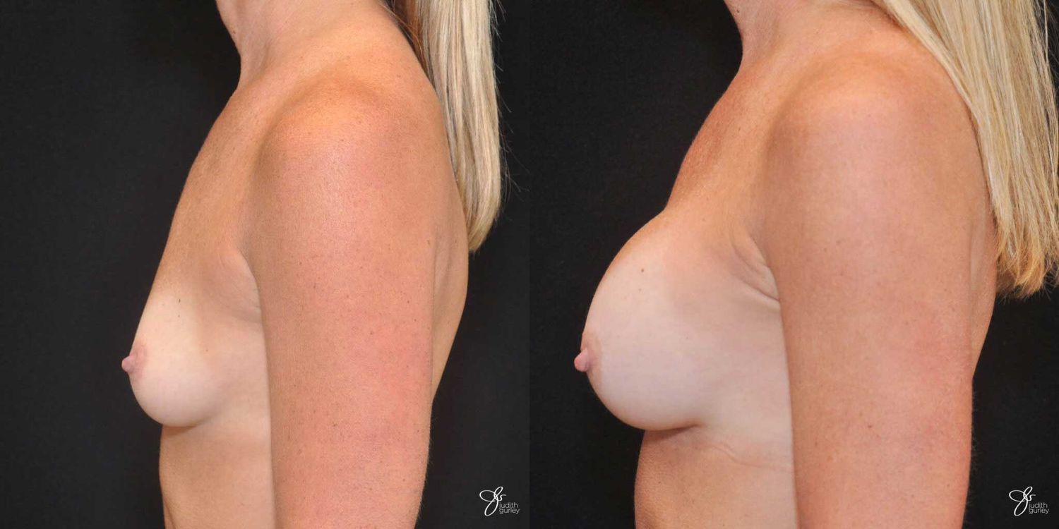 Breast Augmentation Before & After