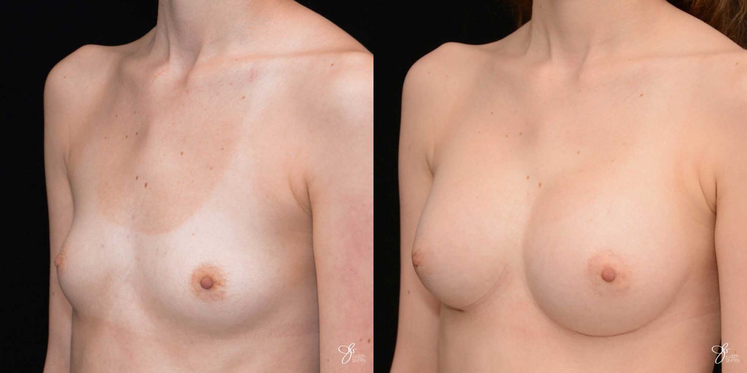 Breast Augmentation Before & After