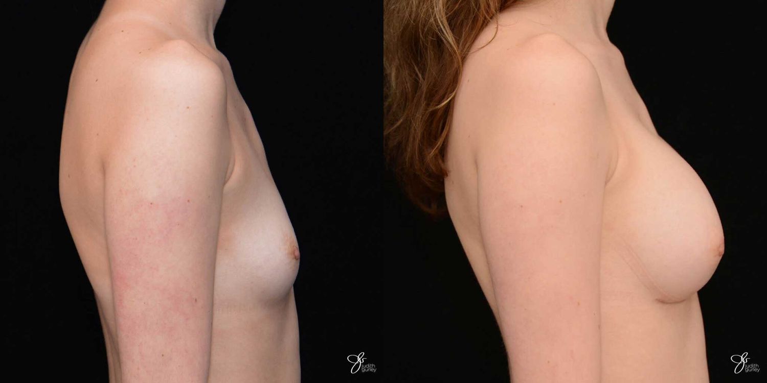 Breast Augmentation Before & After