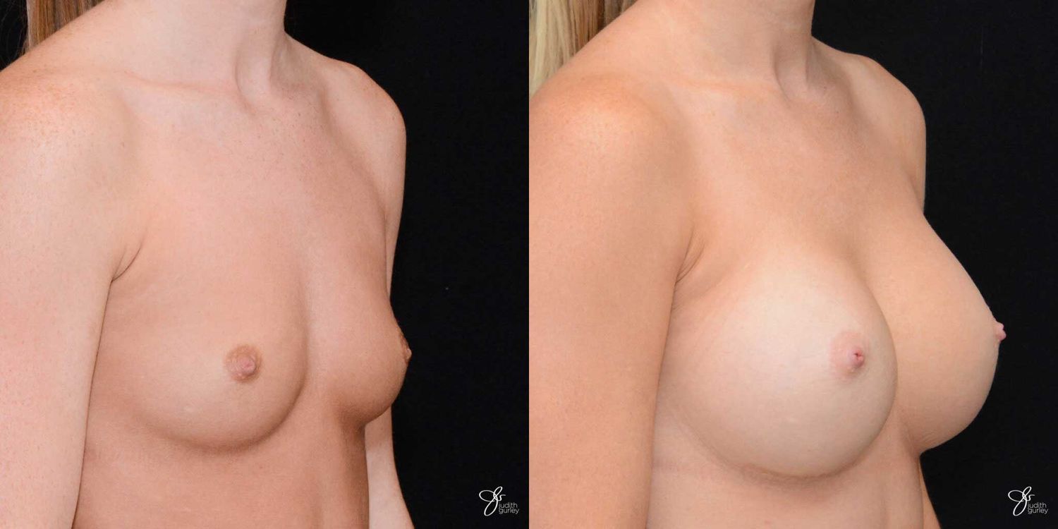 Breast Augmentation Before & After