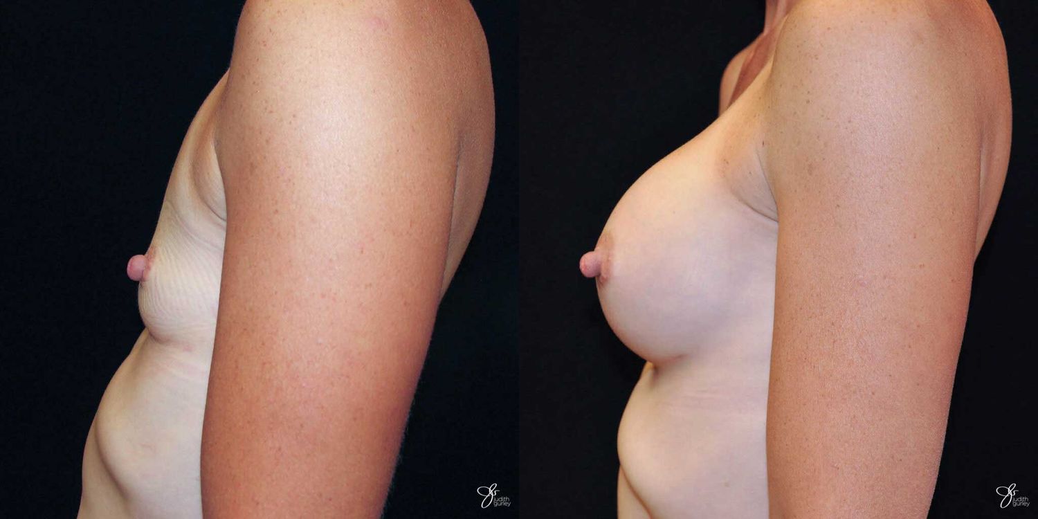Breast Augmentation Before & After