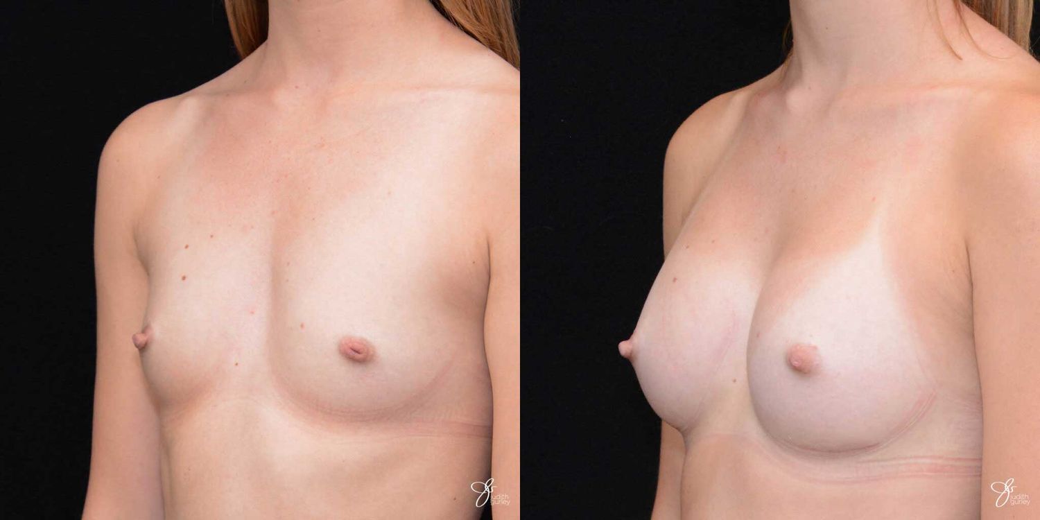 Breast Augmentation Before & After