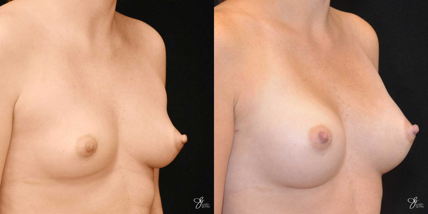 Breast Augmentation Before & After