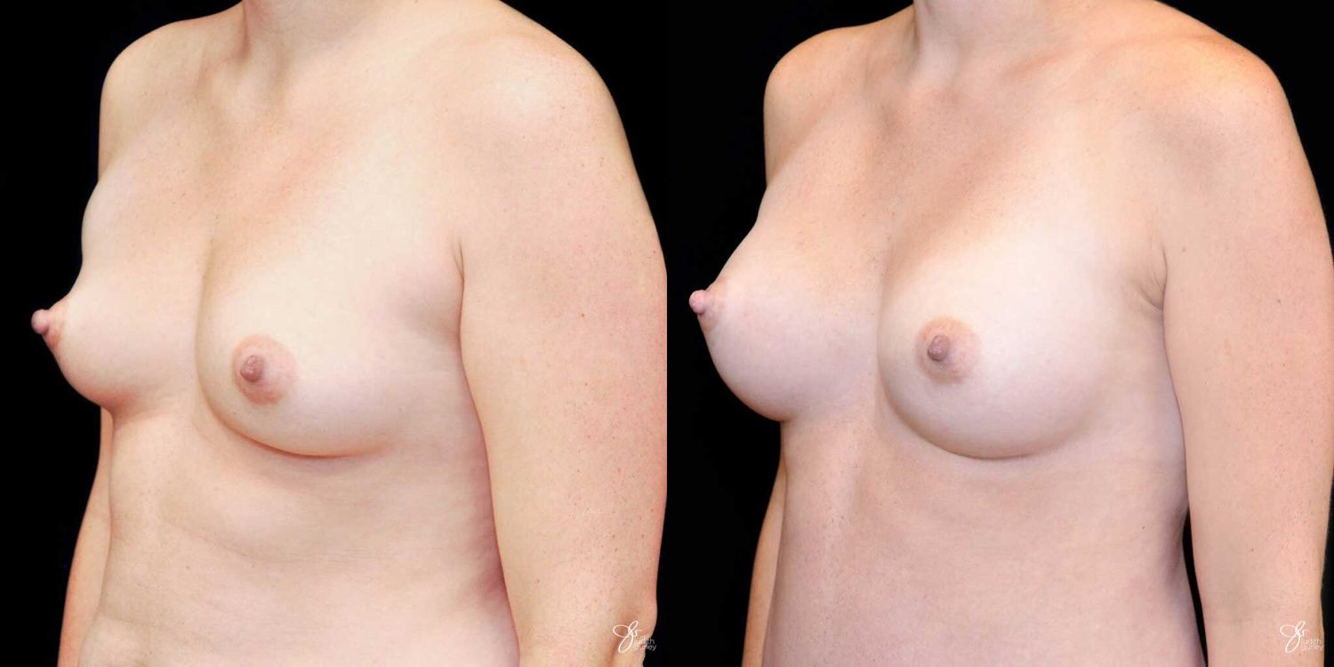 Breast Augmentation Before & After