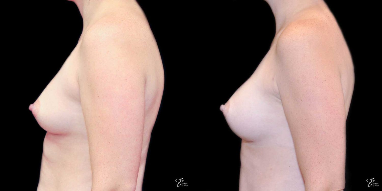 Breast Augmentation Before & After