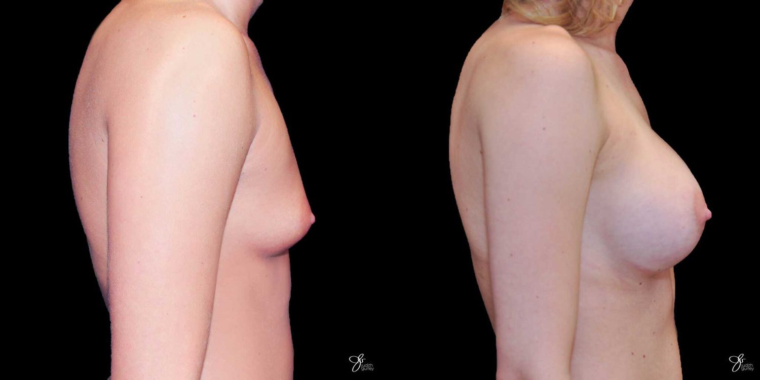 Breast Augmentation Before & After