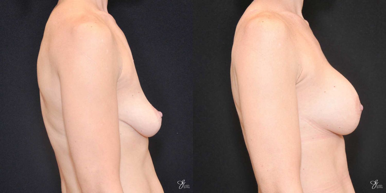 Breast Augmentation Before & After