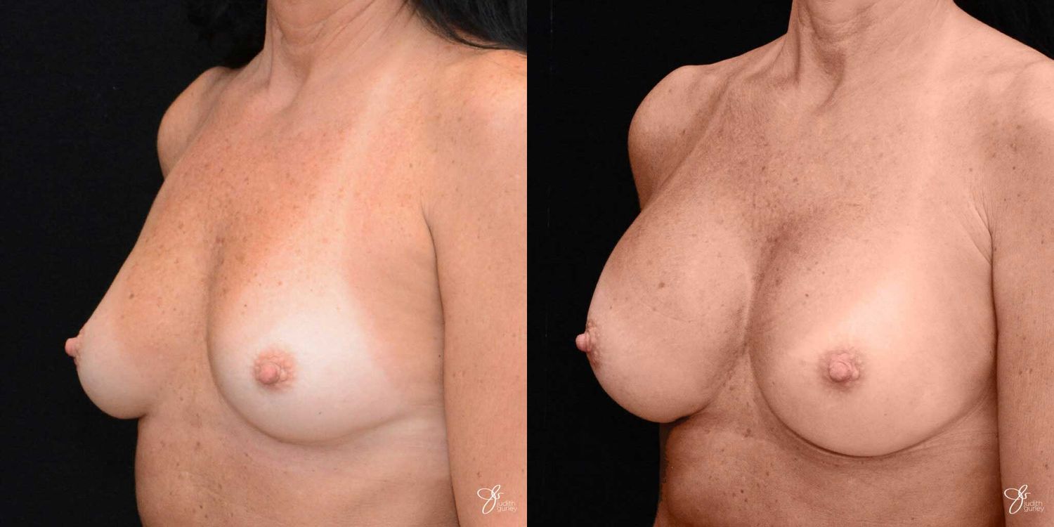 Breast Augmentation Before & After