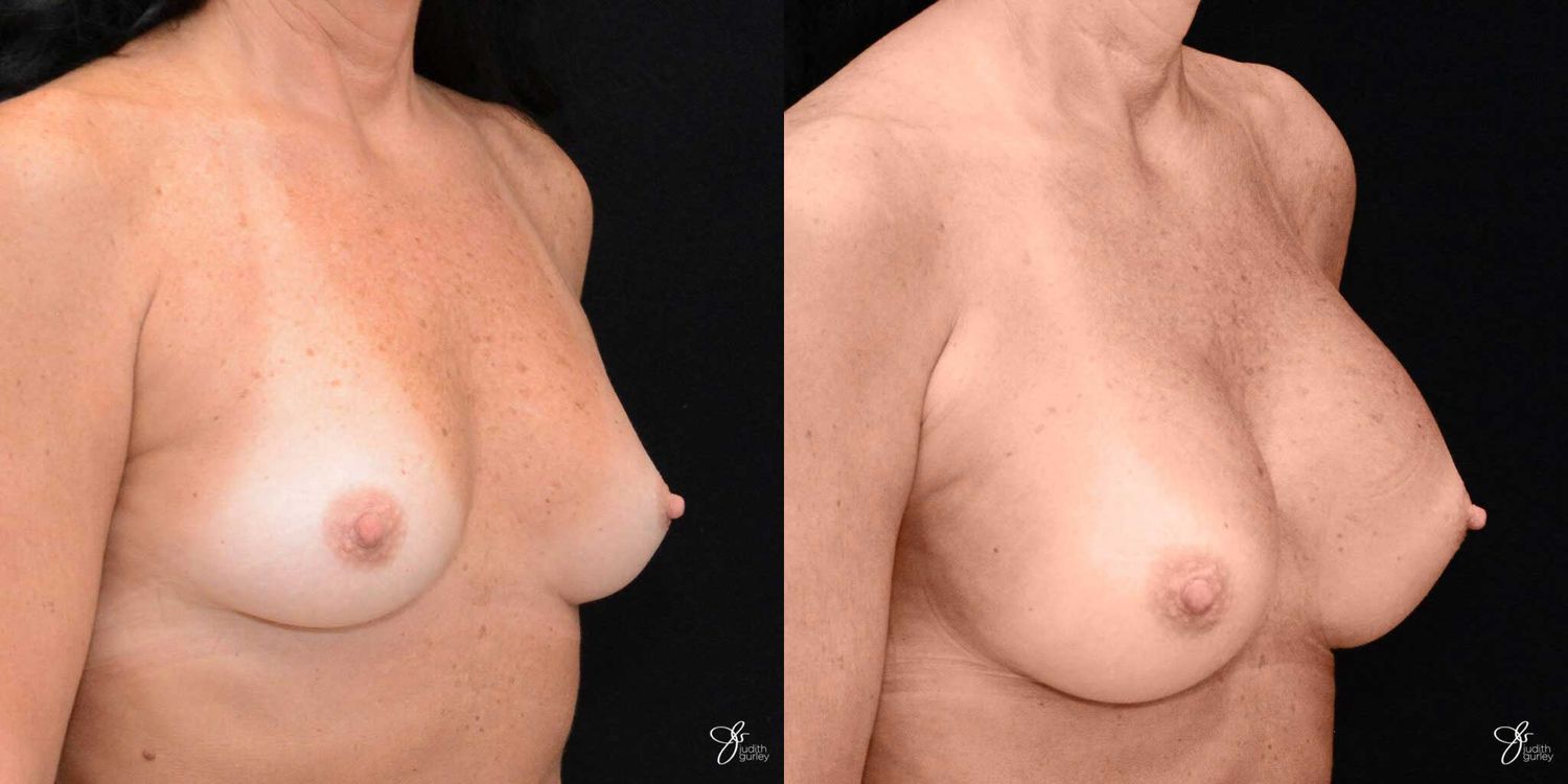 Breast Augmentation Before & After