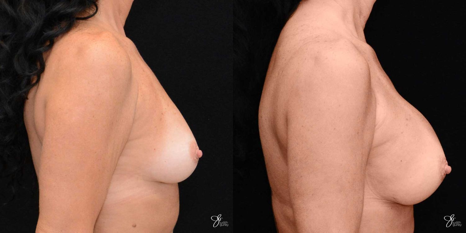Breast Augmentation Before & After