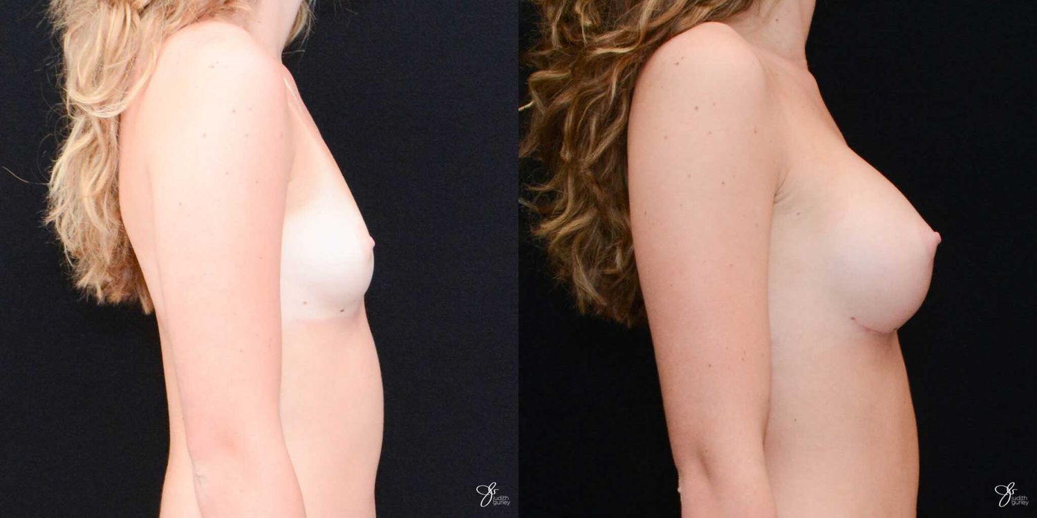 Breast Augmentation Before & After