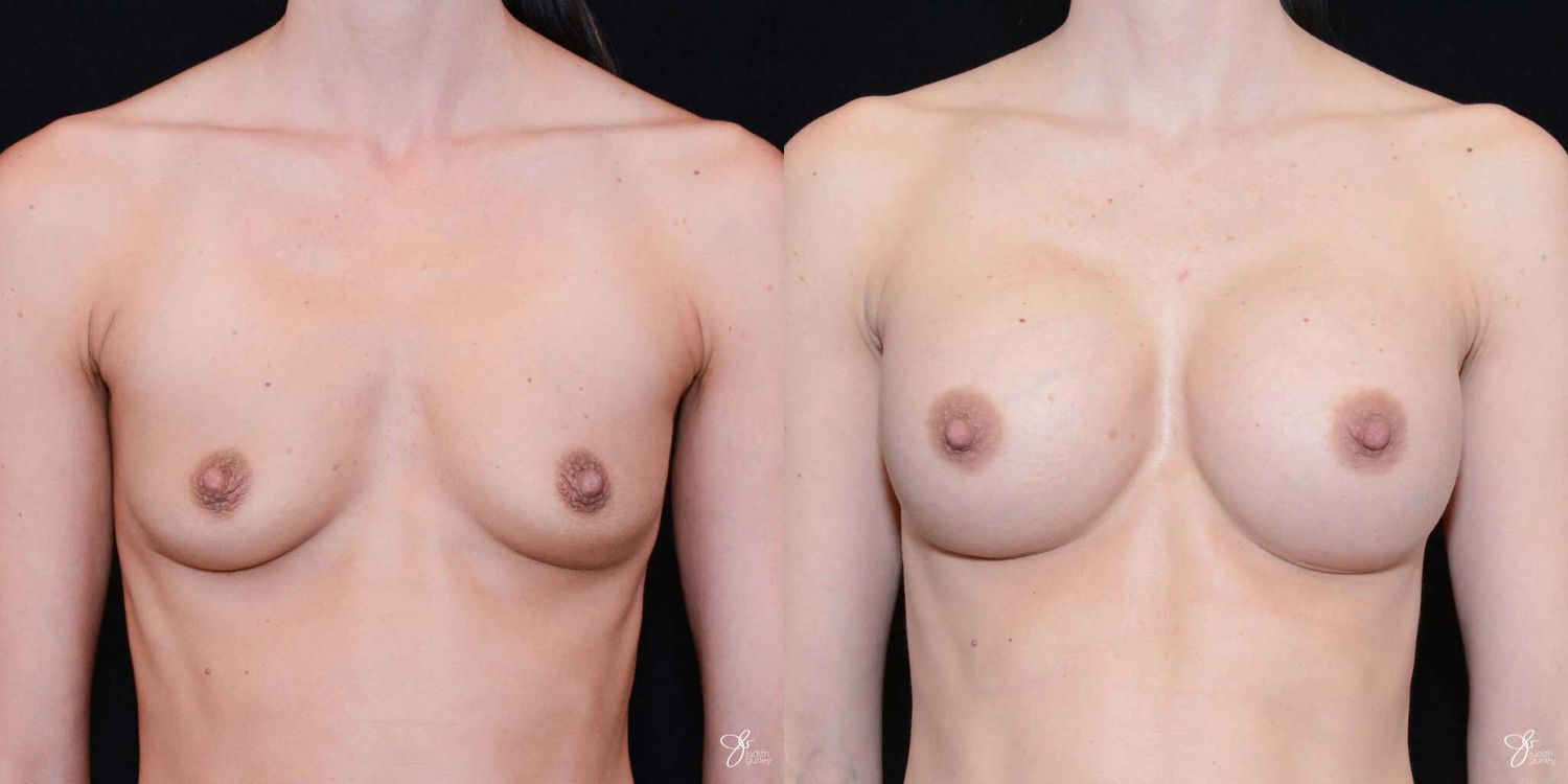 Breast Augmentation Before & After