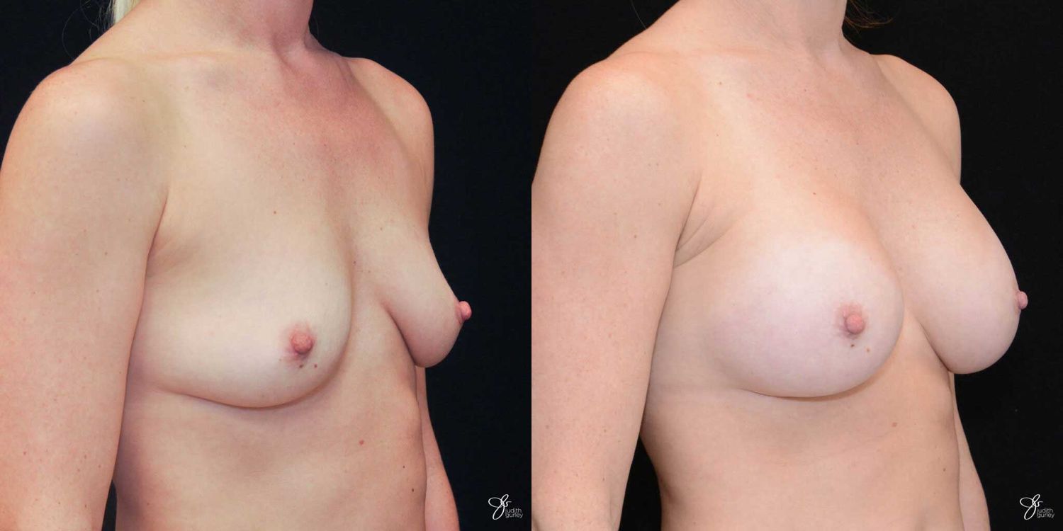 Breast Augmentation Before & After