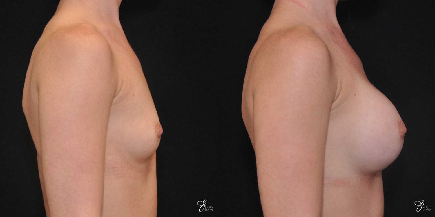 Breast Augmentation Before & After