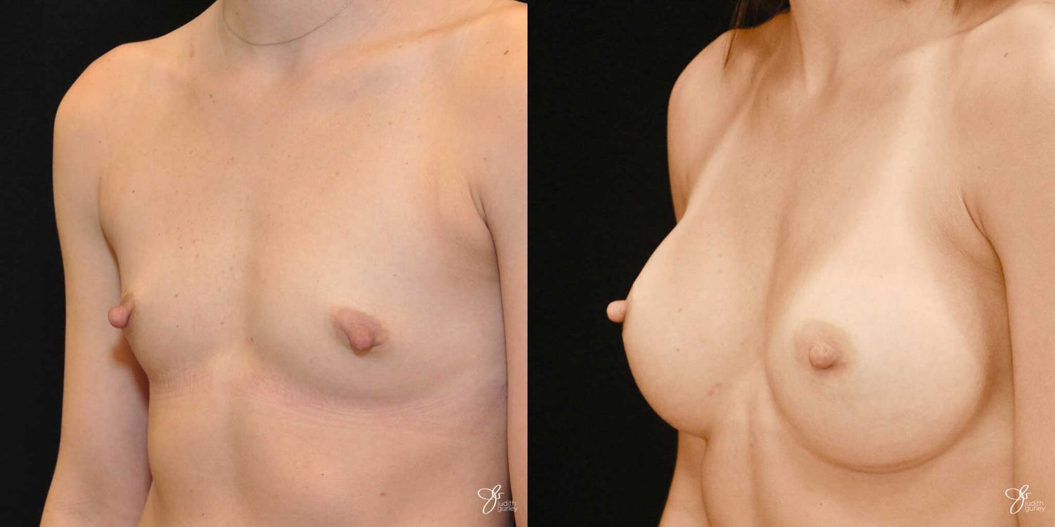 Breast Augmentation Before & After